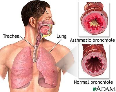 Bronchial Problem
